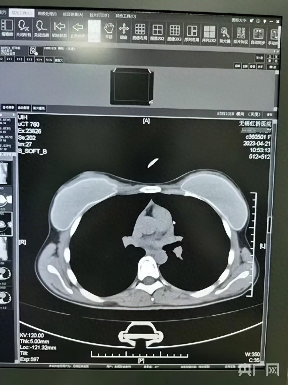 医院被举报骗保：1张CT片套多个病历